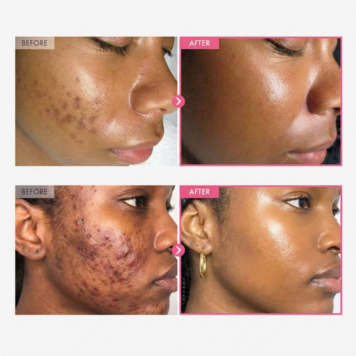 Tranexamic Acid 4% Cream